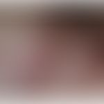 Morbus Crohn, Hautveränderungen: Pyoderma gangraenosum-artige&nbsp;Dermatitis.&nbsp; Abb. entnomm...