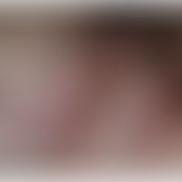 Morbus Crohn, Hautveränderungen: Pyoderma gangraenosum-artige&nbsp;Dermatitis.&nbsp; Abb. entnomm...