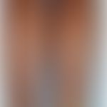 Morbus Crohn, Hautveränderungen: Erythema nodosum.&nbsp;&nbsp;Abb. entnommen aus:&nbsp;Antonelli ...