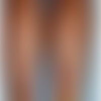 Morbus Crohn, Hautveränderungen: Erythema nodosum.&nbsp;&nbsp;Abb. entnommen aus:&nbsp;Antonelli ...