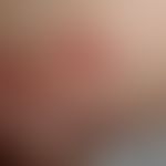 IgA-Pemphigus:&nbsp;flächige erythematöse Plaques mit groblamellärer Abschuppung.&nbsp; Abb. entn...