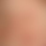 IgA-Pemphigus:&nbsp;flächige erythematöse Plaques mit Blasen und Pusteln. Abb. entnommen aus:&nbs...