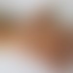 Eczema coxsackium: vesikulöses Exanthem. Hier Befall der Handflächen. Abb. entnommen aus:&nbsp;Ce...