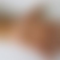 Eczema coxsackium: vesikulöses Exanthem. Hier Befall der Handflächen. Abb. entnommen aus:&nbsp;Ce...