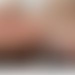 Eczema coxsackium: vesikulöses Exanthem.&nbsp; Abb. entnommen aus:&nbsp;Mathes EF et al. (2013)
