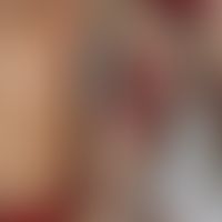 Eczema coxsackium: Vesikulöses Exanthem (pyodermisiert) bei atopischer Dermatitis. Abb. entnommen...