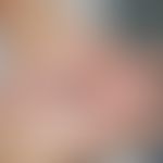 Eczema coxsackium: Vesikulöses Exanthem (pyodermisiert) bei atopischer Dermatitis. Abb. entnommen...
