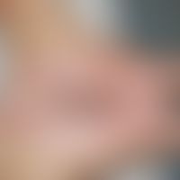 Eczema coxsackium: Vesikulöses Exanthem (pyodermisiert) bei atopischer Dermatitis. Abb. entnommen...