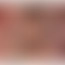 Eosinophile Ösophagitis: endoskopischer Befund. Abb. entnommen aus:&nbsp;Reed CC et al. (2019)

