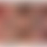 Eosinophile Ösophagitis: endoskopischer Befund. Abb. entnommen aus:&nbsp;Reed CC et al. (2019)
