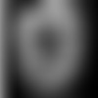 Eosinophile Gastroenteritis (abdominaler CT-Scan): Die Hauptbefunde im abdominalen CT waren eine ...