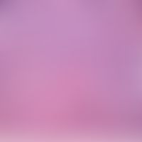 Eosinophile Gastroenteritis (Darmbiopsie/Dickdarm):&nbsp;Darmschleimhaut mit einer Anzahl von &gt...