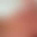 Pseudoporphyrie unter Voriconazol-Therapie. Abb.entnommen aus:&nbsp; Caroppo F et al. (2023). S. ...
