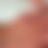 Pseudoporphyrie unter Voriconazol-Therapie. Abb.entnommen aus:&nbsp; Caroppo F et al. (2023). S. ...