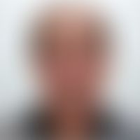 Morbus Morbihan: Chronisch persistierende Lidschwellungen. Abb. entnommen aus: Suzuki M et al.(20...