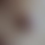Lymphocytic infiltration of the skin: seit mehreren Wochen&nbsp;bestehender, derb elastischer, sc...