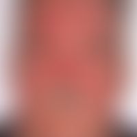 Morbus Morbihan: Intialbefund mit flächenhafter fazialer Rötung und Schwellung.&nbsp;&nbsp;
