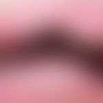 Ascher-Syndrom: Lippenschwellung durch Doppellippe. Abb. entnommen aus:&nbsp;Donato CMG et al. (2...