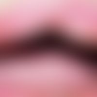 Ascher-Syndrom: Lippenschwellung durch Doppellippe. Abb. entnommen aus:&nbsp;Donato CMG et al. (2...