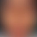 Ascher-Syndrom: Lippenschwellung durch Doppellippe. Abb. entnommen aus:&nbsp;Rewri P et al. (2023).
