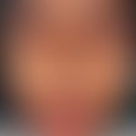 Ascher-Syndrom: Lippenschwellung durch Doppellippe. Abb. entnommen aus:&nbsp;Rewri P et al. (2023).

