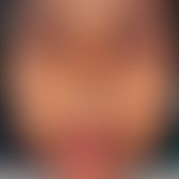 Ascher-Syndrom: Lippenschwellung durch Doppellippe. Abb. entnommen aus:&nbsp;Rewri P et al. (2023).
