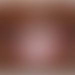Ascher-Syndrom: Lippenschwellung durch Doppellippe. Abb. entnommen aus:&nbsp;Al-Hassani M et al. ...