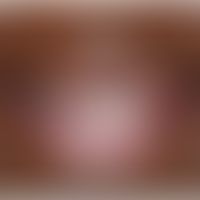 Ascher-Syndrom: Lippenschwellung durch Doppellippe. Abb. entnommen aus:&nbsp;Al-Hassani M et al. ...