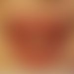 Ascher-Syndrom: Lippenschwellung durch Doppellippe. Abb. entnommen aus:&nbsp;Al-Hassani M et al. ...