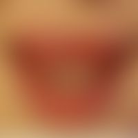 Ascher-Syndrom: Lippenschwellung durch Doppellippe. Abb. entnommen aus:&nbsp;Al-Hassani M et al. ...