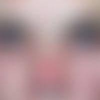 Rosazea okuläre: chronische&nbsp; Rötung und Schwellung des Unterlids mit entzündlichen Papeln un...
