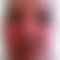 Morbus Morbihan: chronische inflammatorische faziale und blepharische Schwellung. Abb. entnommen ...