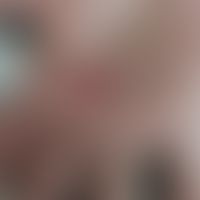 Erythema multiforme: klassische Kokardenformation. EM nach Covid-Vakzinierung. Abb. entnommen aus...