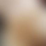 Ausgedehnte Morphea nach Strahlentherapie&nbsp;mit Depigmentierungen. Abb. entnommen aus: Machan ...