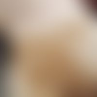 Ausgedehnte Morphea nach Strahlentherapie&nbsp;mit Depigmentierungen. Abb. entnommen aus: Machan ...