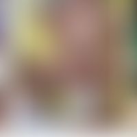 CHILD-Syndrom: unilateraler&nbsp;verruköser Naevus.&nbsp; Abb. entnommen aus&nbsp;Maceda EBG et a...