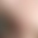 Strahleninduzierte Morphea: Mamma-Ca, adjuvante Radiatio. Ca. drei Monate später Beginn der Verän...