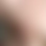 Strahleninduzierte Morphea: Mamma-Ca, adjuvante Radiatio. Ca. drei Monate später Beginn der Verän...