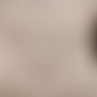 Pityriasis rosea: Mann, 17 Jahre. Seit 4 Wochen bestehend. Geringer Juckreiz. Gut sichtbar bei me...