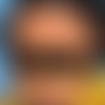 Megalenzephalie-Kapillarmissbildungs-Polymikrogyrie-Syndrom: Retikuläre kapilläre Malformation. B...