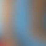 Megalenzephalie-Kapillarmissbildungs-Polymikrogyrie-Syndrom: Retikuläre kapilläre Malformation. B...