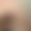 Dermales undifferenziertes pleomorphes Sarkom: großer ulzerierter Knoten (Abbildung zur Verfügung...