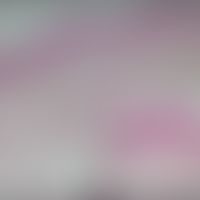 Angioma serpiginosum: histologische Darstellung mit Ampullen-artig erweiterten Kapillaren in den ...
