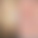 Angioma serpiginosum: Auflichtmikrskopie mit hoher Auflösung. Punktförmige Gefäßektasien. Abb. en...
