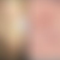 Angioma serpiginosum: Auflichtmikrskopie mit hoher Auflösung. Punktförmige Gefäßektasien. Abb. en...