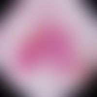 Angioma serpiginosum : Auflichtmikroskopisches Bild mit punktförmigen Kapillarektasien. Abb. entn...