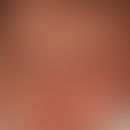 Sturge-Weber-Krabbe-Syndrom: Naevus flammeus mit Beteiligung der linken Gesichtshälfte und der St...