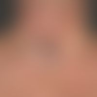 Venöse Malformationen unifokale (isolierte): Kutane Knötchen und Knoten, weiche subkutane Schwell...