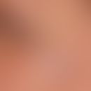 Venöse Malformationen unifokale (isolierte): umschriebene kutane venöse Malformation. Keine klini...