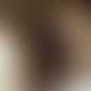 Cobb-Syndrom: Tubero-nodös transformierter Naevus flammeus mit ausgedehntem subkutan-venösen Ante...